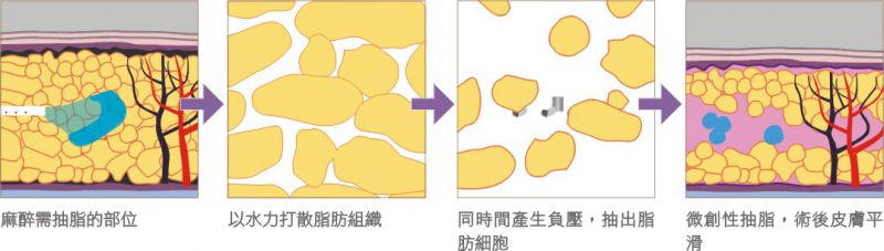 水刀抽脂和雷射溶脂的手术方式和适用人群有什么不同