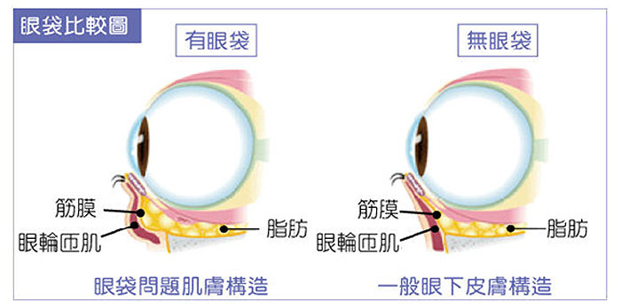 眼袋形成的原因是什么？眼轮匝肌筋膜层松弛