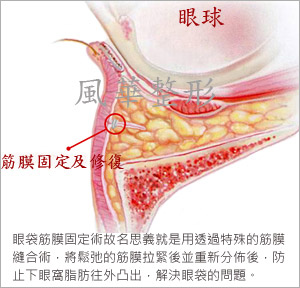 什么是内开式眼袋移位，筋膜修补固定术？祛眼袋详解