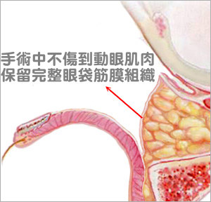 什么是内开式眼袋移位，筋膜修补固定术？祛眼袋详解