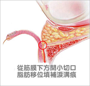 什么是内开式眼袋移位，筋膜修补固定术？祛眼袋详解