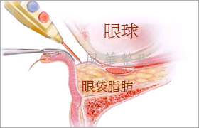 什么是内开式眼袋移位，筋膜修补固定术？祛眼袋详解