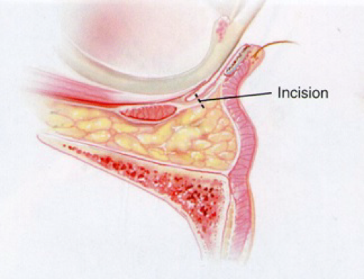 什么是眼袋脂肪归位（fat relocation）？什么是眼袋脂肪移位（fat reposition）？