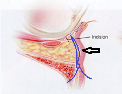 什么是眼袋脂肪归位（fat relocation）？什么是眼袋脂肪移位（fat reposition）？