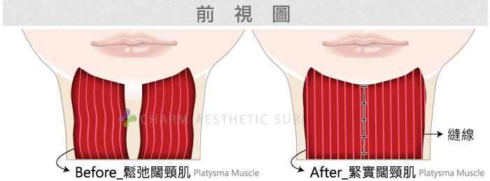 改善脸颊及火鸡脖子最有效的方法：筋膜下拉皮(SMAS拉皮)