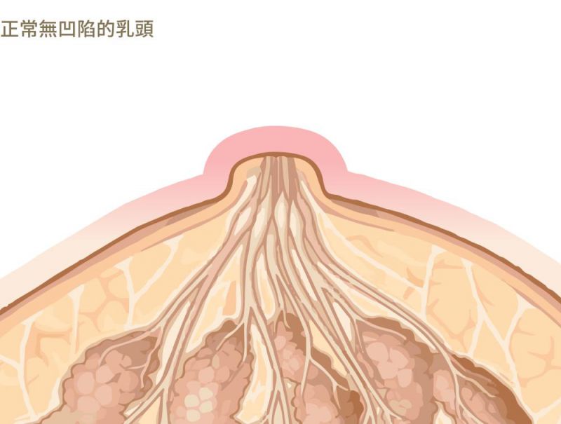 乳头凹陷怎么办？" 多层次"Z形皮瓣乳头凹陷矫正术