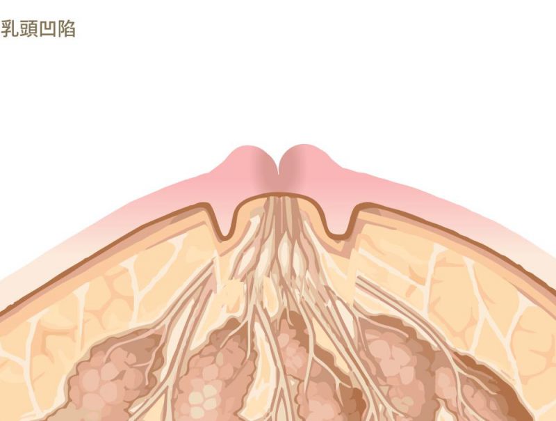 乳头凹陷怎么办？" 多层次"Z形皮瓣乳头凹陷矫正术