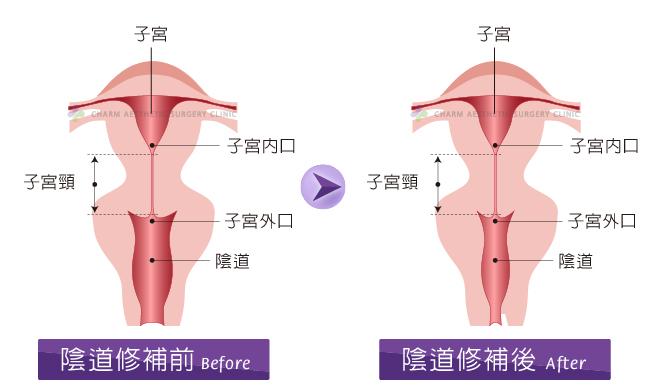 阴道松弛怎么办？认识Fotona Dynamis Line Laser “富多拿”黛娜美斯雷射