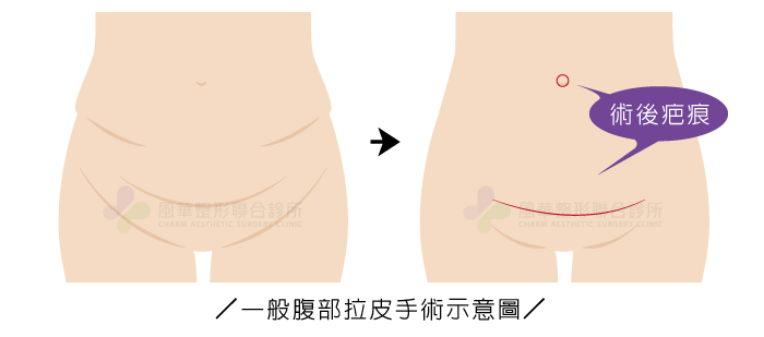 肥胖、腹部松弛(肚皮松垮)及妊娠纹怎么解决？腹部拉皮手术