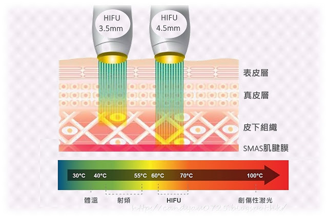 Ultra V 无针埋线 让面部轮廓瞬间紧致提升