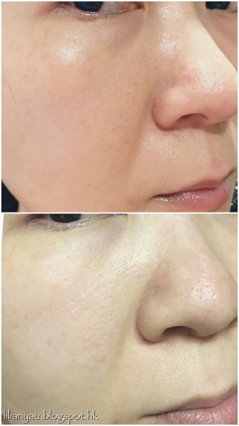 什么是Derma Vei第二代l童颜针？Derm a Veil童颜针有什么特点？