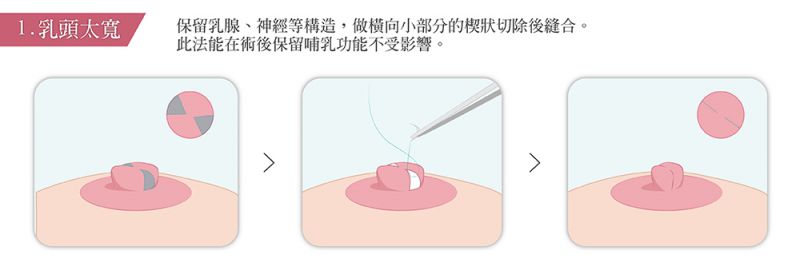 乳头乳晕有哪些整形手术方式？乳头缩小乳晕缩小乳头内陷乳头再造