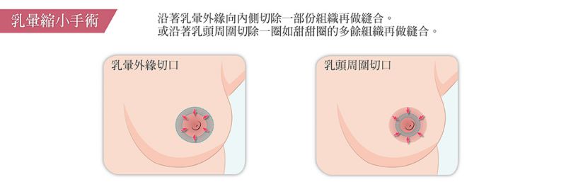 乳头乳晕有哪些整形手术方式？乳头缩小乳晕缩小乳头内陷乳头再造