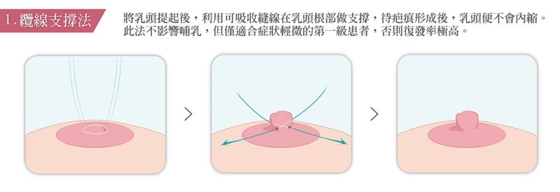 乳头乳晕有哪些整形手术方式？乳头缩小乳晕缩小乳头内陷乳头再造