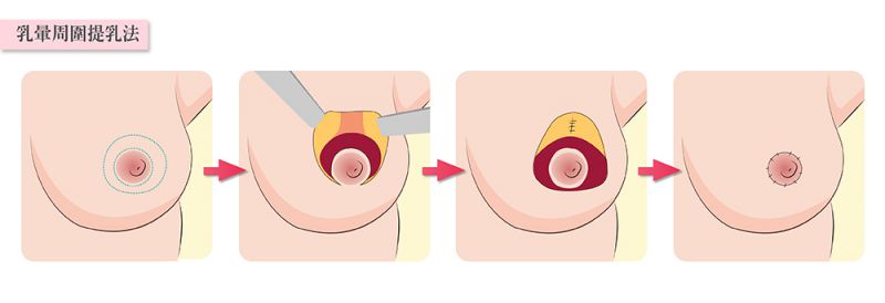 乳房下垂有哪几种手术改善方式？轻度中度重度乳房下垂矫正