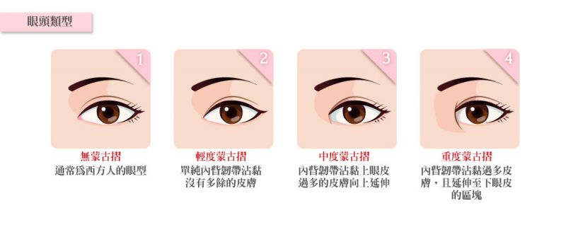 为什么要做开眼头（开眼角）手术？哪些人需要做开眼头？