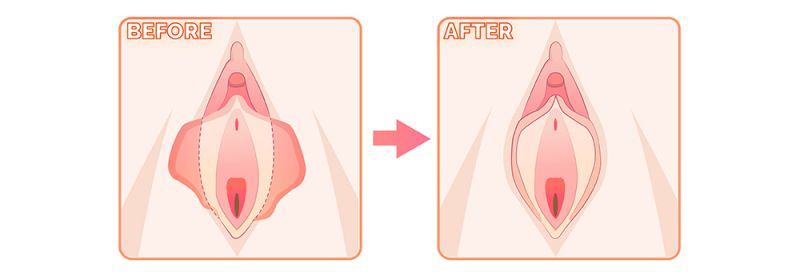 私密整形手术方式详解：小阴唇大阴唇整形阴道松弛处女膜修补