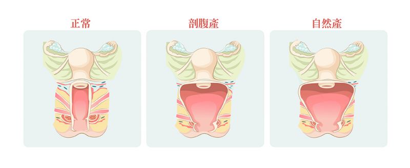 私密整形手术方式详解：小阴唇大阴唇整形阴道松弛处女膜修补