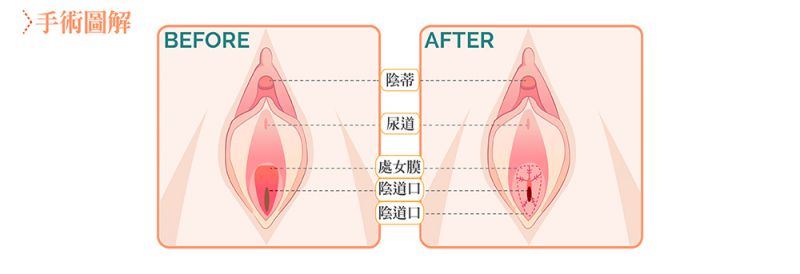 私密整形手术方式详解：小阴唇大阴唇整形阴道松弛处女膜修补