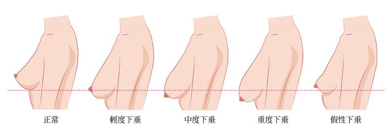 胸大未必是美 缩胸平胸（巨乳缩小）手术分为哪几种？