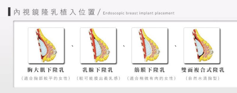 什么是内视镜隆乳？内窥镜隆胸的手术切口在哪里？