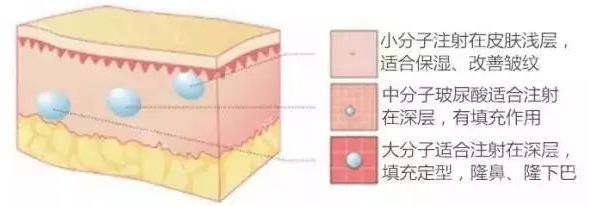 侯典举：脂肪填充和玻尿酸填充保持时间谁更长一些？