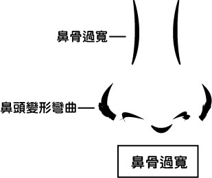 鼻梁整型手术有哪几种？鼻骨过宽、鼻骨变形弯曲马鞍鼻驼峰鼻鹰钩鼻