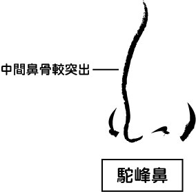 鼻梁整型手术有哪几种？鼻骨过宽、鼻骨变形弯曲马鞍鼻驼峰鼻鹰钩鼻