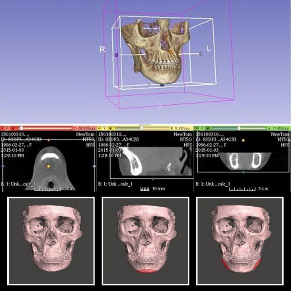 3D下巴整形手术-3D列印垫下巴手术 有什么优点？