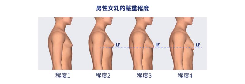 男性女乳症有哪些手术方式可以解决？乳腺切除乳房抽脂