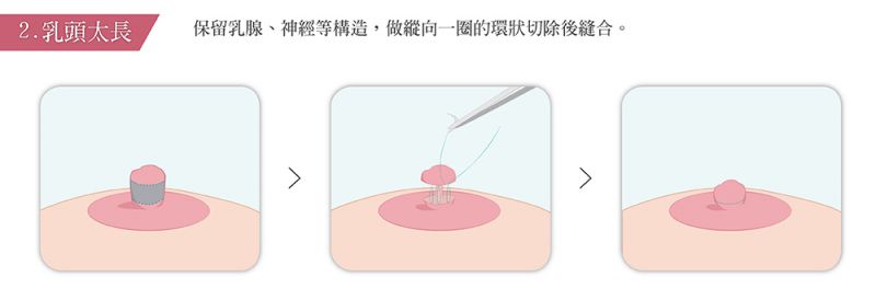 乳头缩小乳晕缩小乳头内陷矫正乳头再造乳晕再造详解