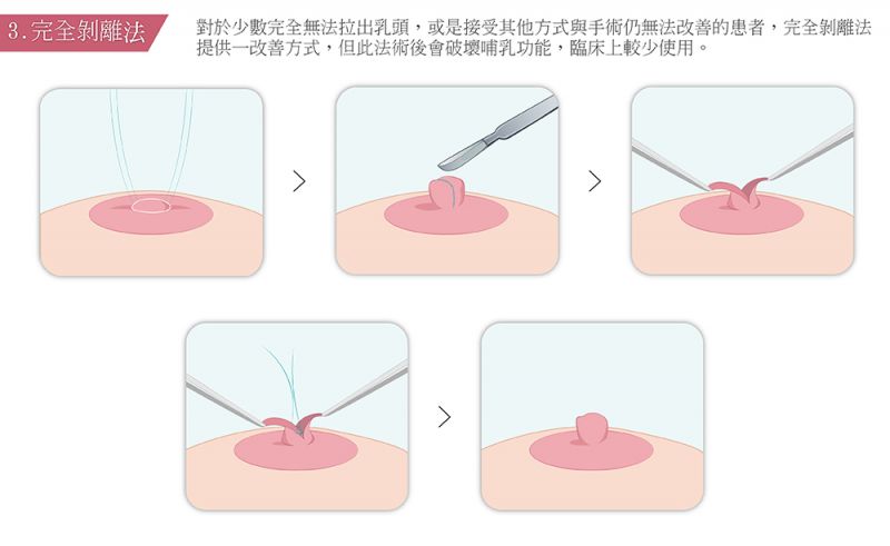 乳头缩小乳晕缩小乳头内陷矫正乳头再造乳晕再造详解