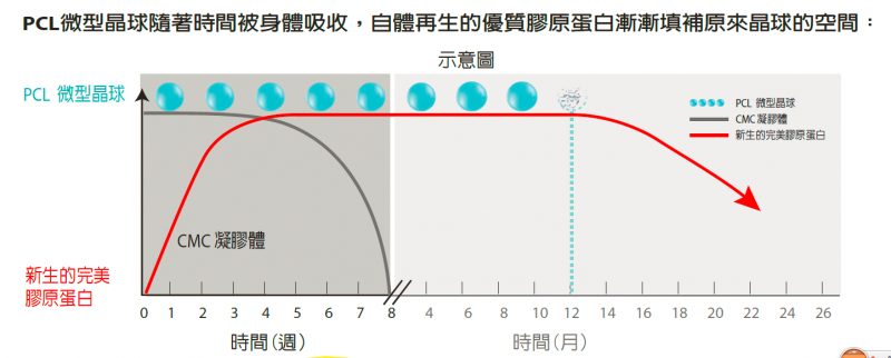 什么是Ellanse洢莲丝（依恋诗）？Ellanse洢莲丝（依恋诗）是玻尿酸吗？