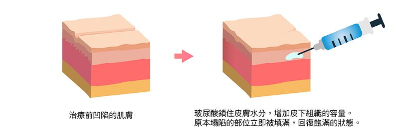 什么是玻尿酸？玻尿酸可用「分子大小」与「剂型」来做分类