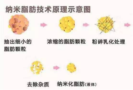 什么是纳米脂肪填充移植？纳米脂肪填充和常规脂肪移植有什么区别？