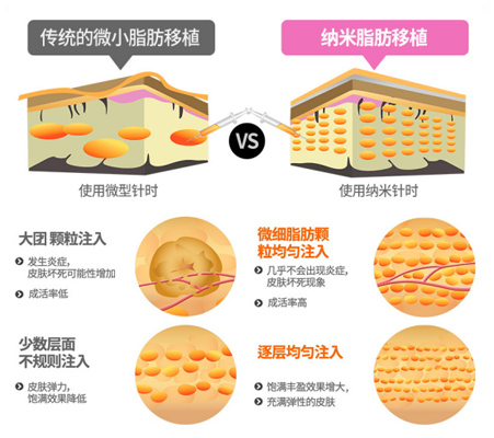 什么是纳米脂肪填充移植？纳米脂肪填充和常规脂肪移植有什么区别？