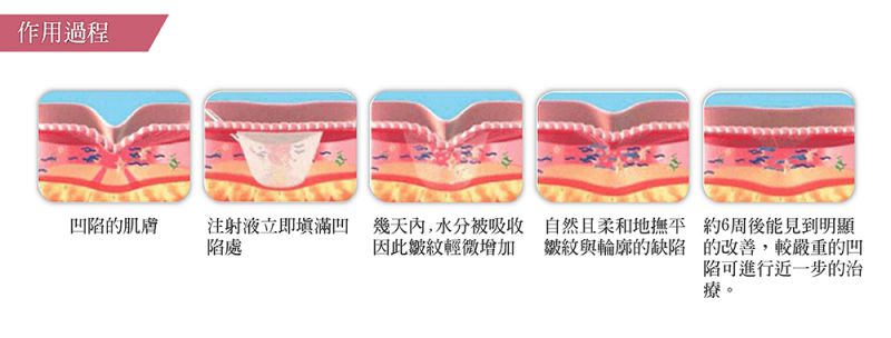 什么是Sculptra®舒颜萃？Sculptra®舒颜萃玻尿酸的效果怎么样？