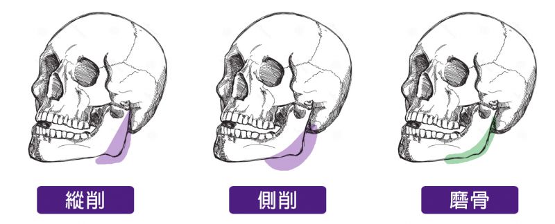 下颚骨角(腮帮子)磨腮削骨手术简介