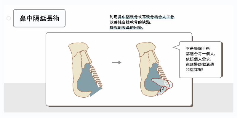 鼻中膈延长、鼻中膈弯曲手术简介 鼻中膈延长、鼻中膈弯曲手术怎么做？