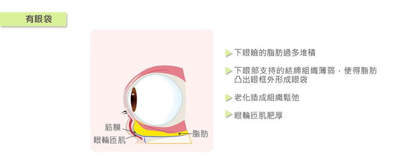 眼睛下的是眼袋还是卧蚕？黑黑的就是眼袋吗？假性眼袋跟真性眼袋是什么？