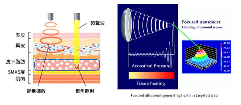 真正非侵入式拉皮：电波拉皮、音波拉皮原理简介