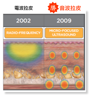 真正非侵入式拉皮：电波拉皮、音波拉皮原理简介