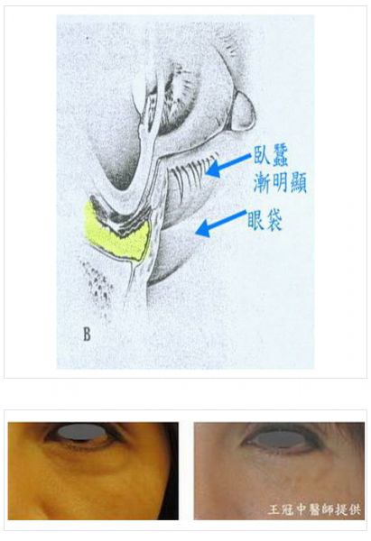 初级的眼袋注射肉毒素 再老化的眼袋必须要注射玻尿酸吗？