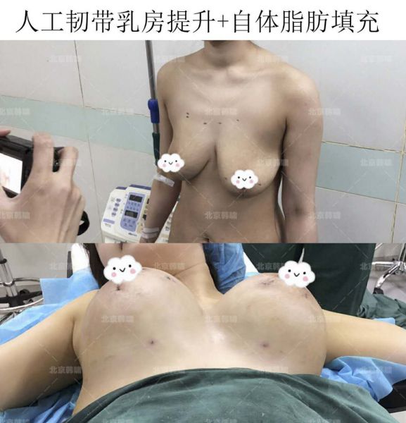 乳房下垂严重怎么办？人工韧带乳房提升术（不开刀乳房上提术）