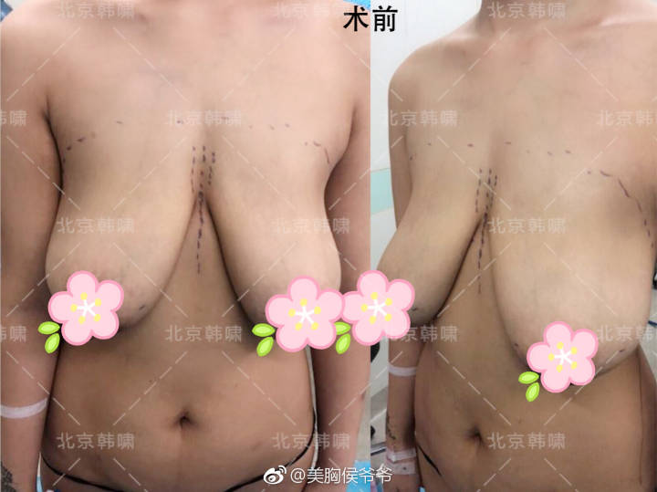 乳房下垂严重怎么办？人工韧带乳房提升术（不开刀乳房上提术）