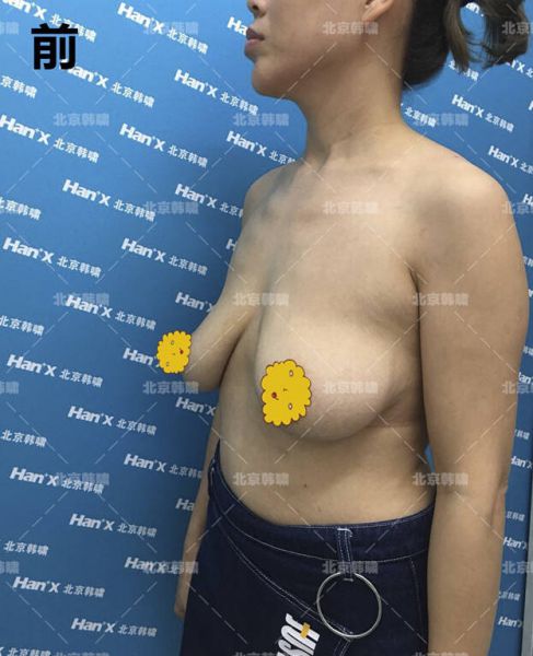 乳房下垂严重怎么办？人工韧带乳房提升术（不开刀乳房上提术）