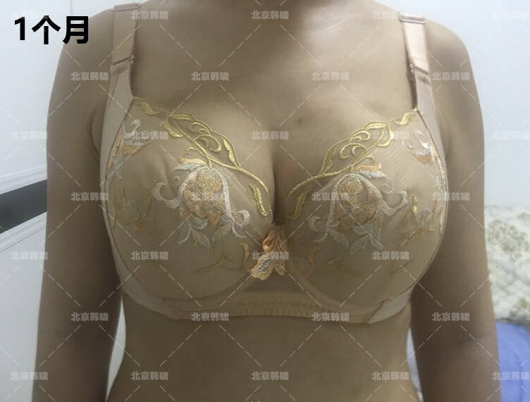 乳房下垂严重怎么办？人工韧带乳房提升术（不开刀乳房上提术）