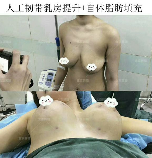 乳房下垂严重怎么办？人工韧带乳房提升术（不开刀乳房上提术）