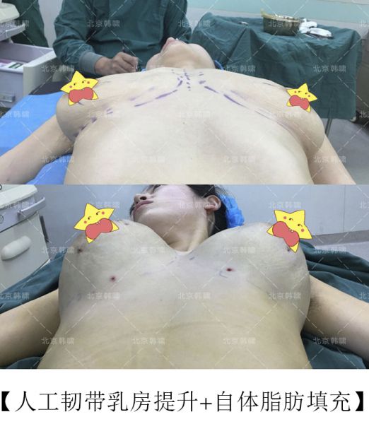 乳房下垂严重怎么办？人工韧带乳房提升术（不开刀乳房上提术）