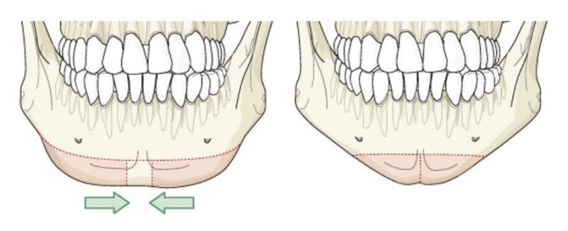 到底该垫下巴或削骨正颚手术？下巴到底重要不重要？看图片来说话